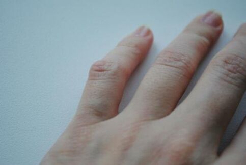 На малкия пръст се появи артритна бучка. 