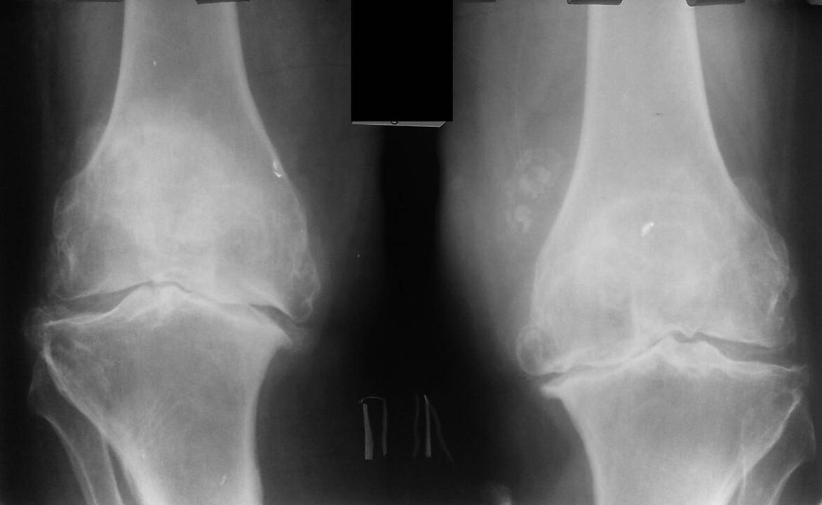 рентгенова снимка на коленни стави с артроза