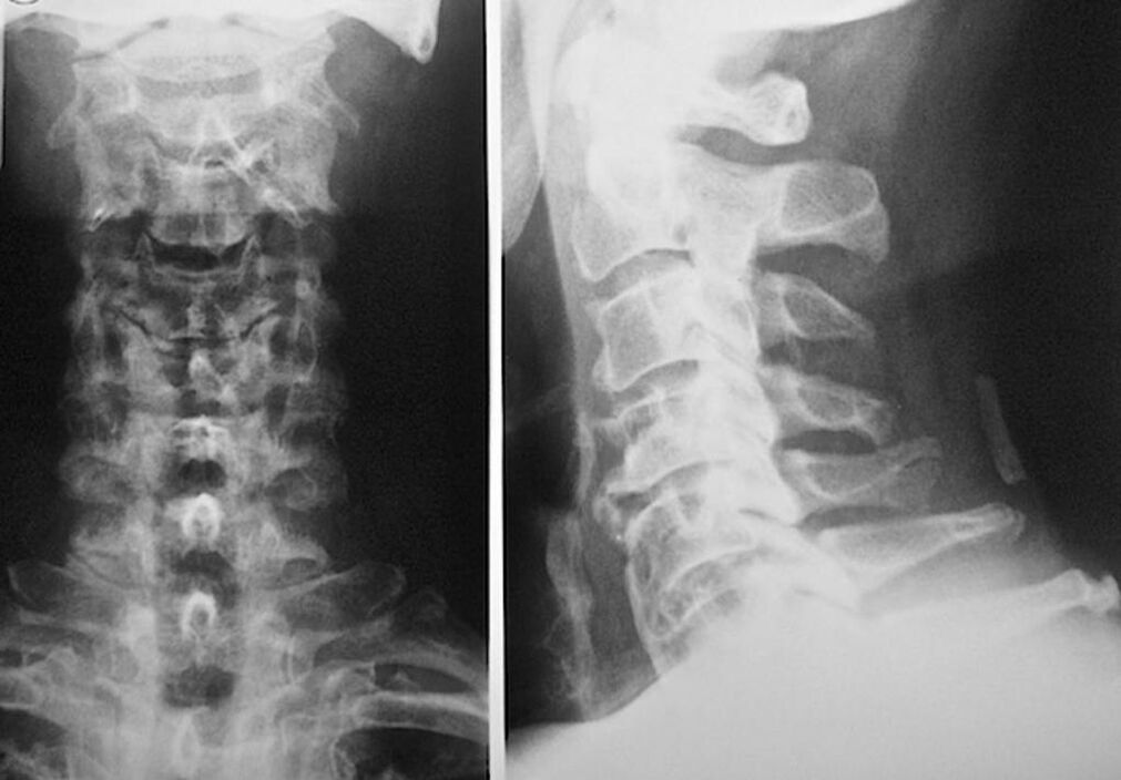 рентгенова снимка на шийните прешлени с остеохондроза