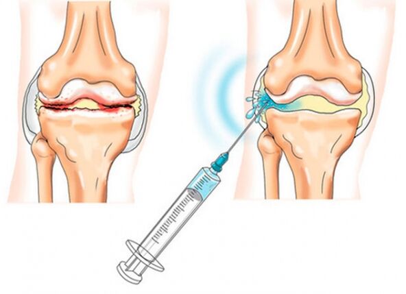 вътреставни инжекции за артроза на коляното
