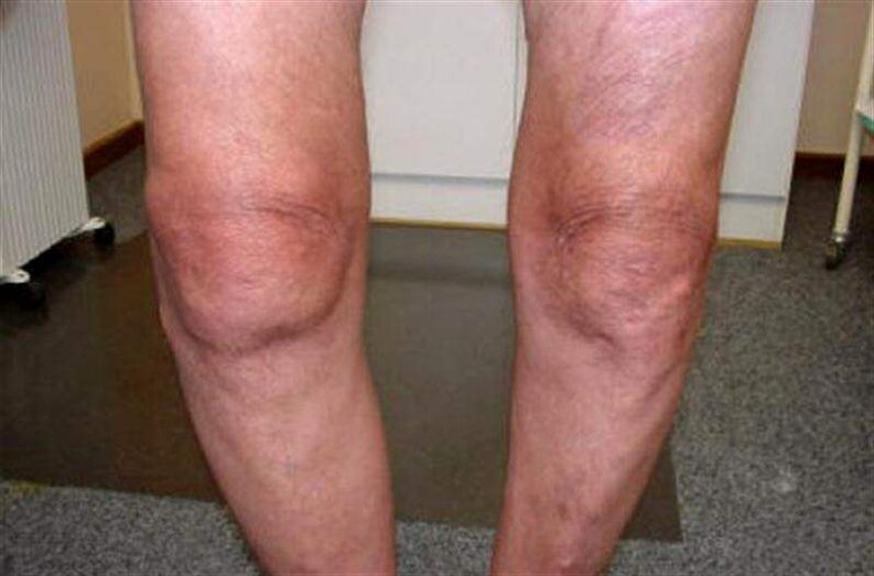 подуване на коляното поради артрит