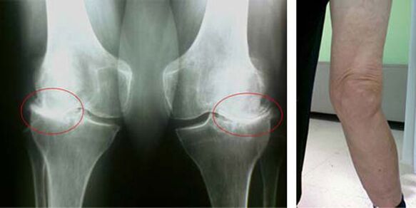 рентгенова снимка на остеоартрит на коляното