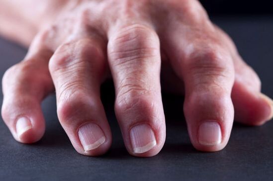 Ставни деформации на пръстите поради артроза или артрит